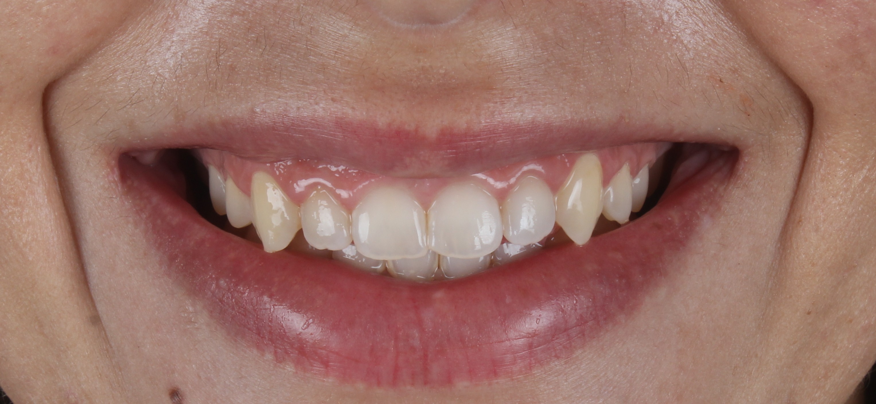 Antes da gengivoplastia